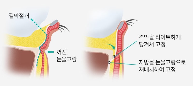 눈밑성형에 격막 강화란 무엇인가요? [눈밑지] 관련 이미지 5