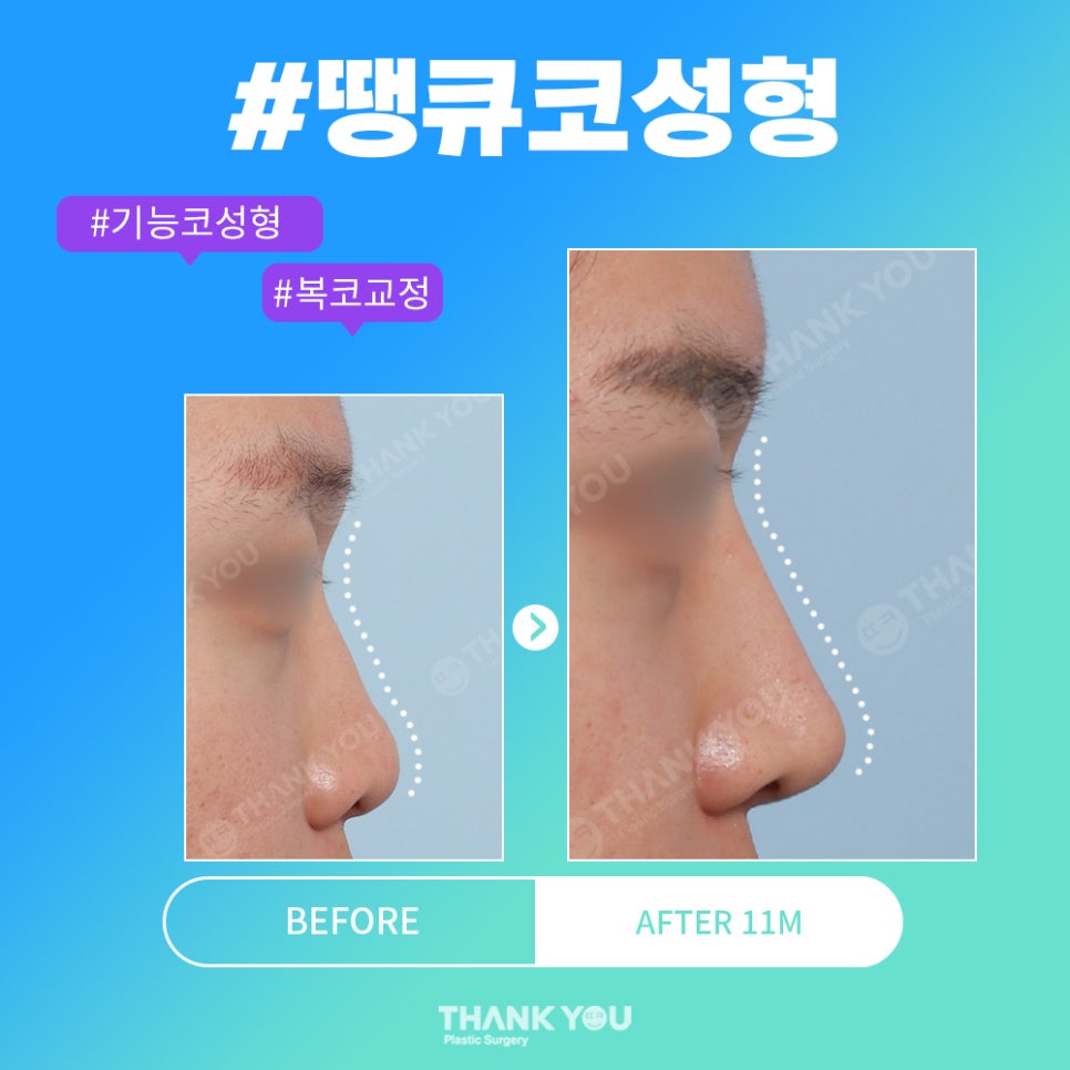 코성형 전후, 코모양 신논현역 성형외과에서 체크 관련 이미지 1