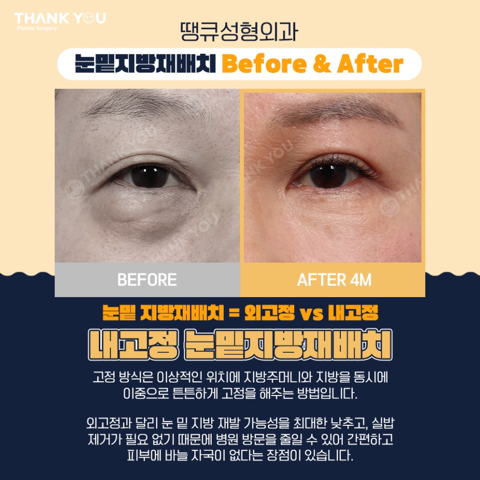 땡큐성형외과 이호준 원장님, 눈밑지방재배치 외고정vs내고정 차이점 관련 이미지 7
