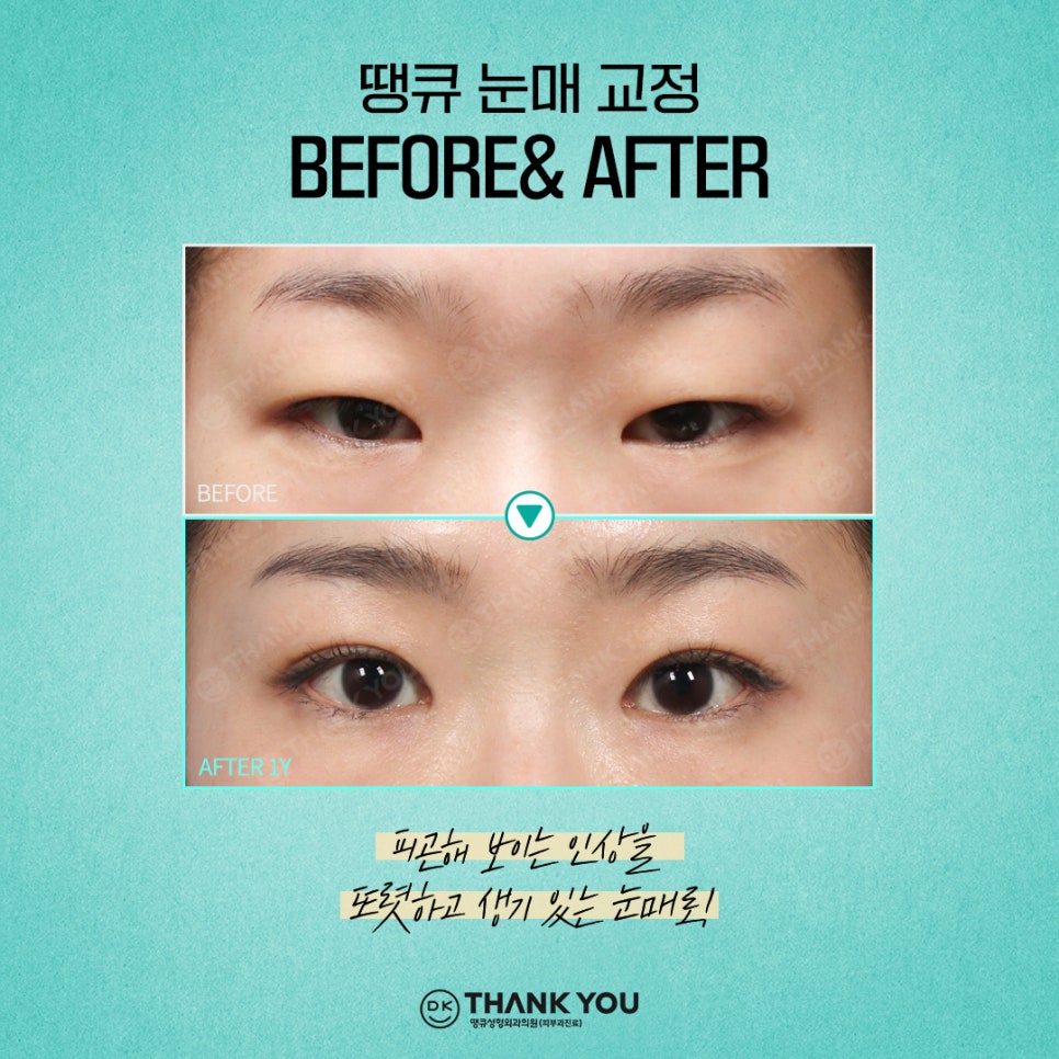 첫눈성형 후기 좋은 땡큐에서 만드는 예쁜 눈매💚 관련 이미지 10