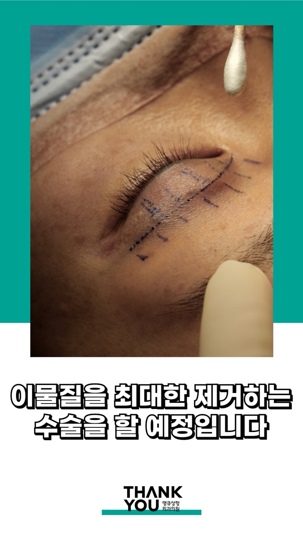 3번 눈재수술? 근데 실제거를 안했다고? 땡큐에서 전부 실제거! 관련 이미지 15