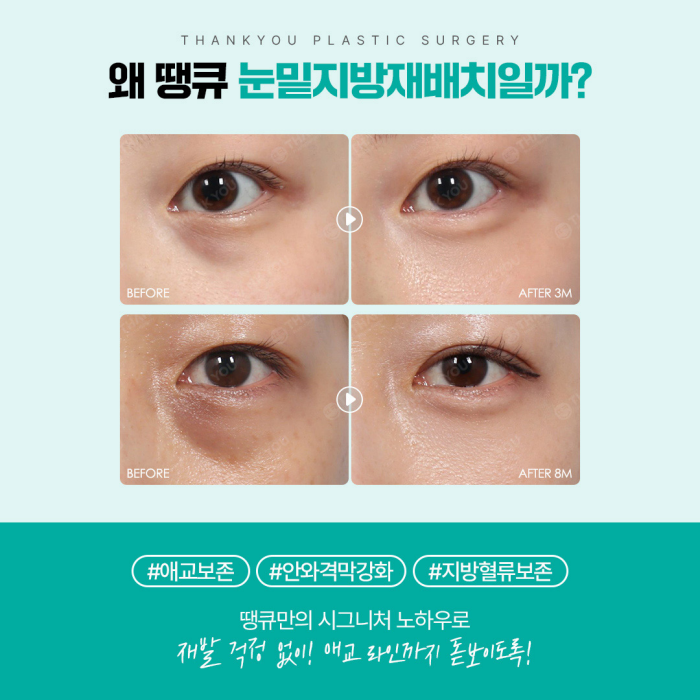 광일병 in 땡큐성형외과 ✨ 눈밑지 & 다크서클 편 공개 관련 이미지 6