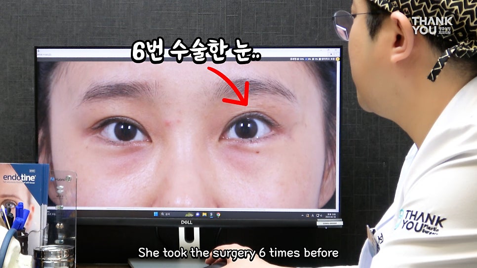 비대칭눈 교정(짝짝이 쌍꺼풀) 헤링의 법칙이란? 관련 이미지 19