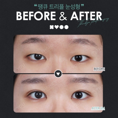 Thank You’s Exam Taker Event at a Great Place for Eye Surgery! ✨Triple Eye Surgery✨ image 13
