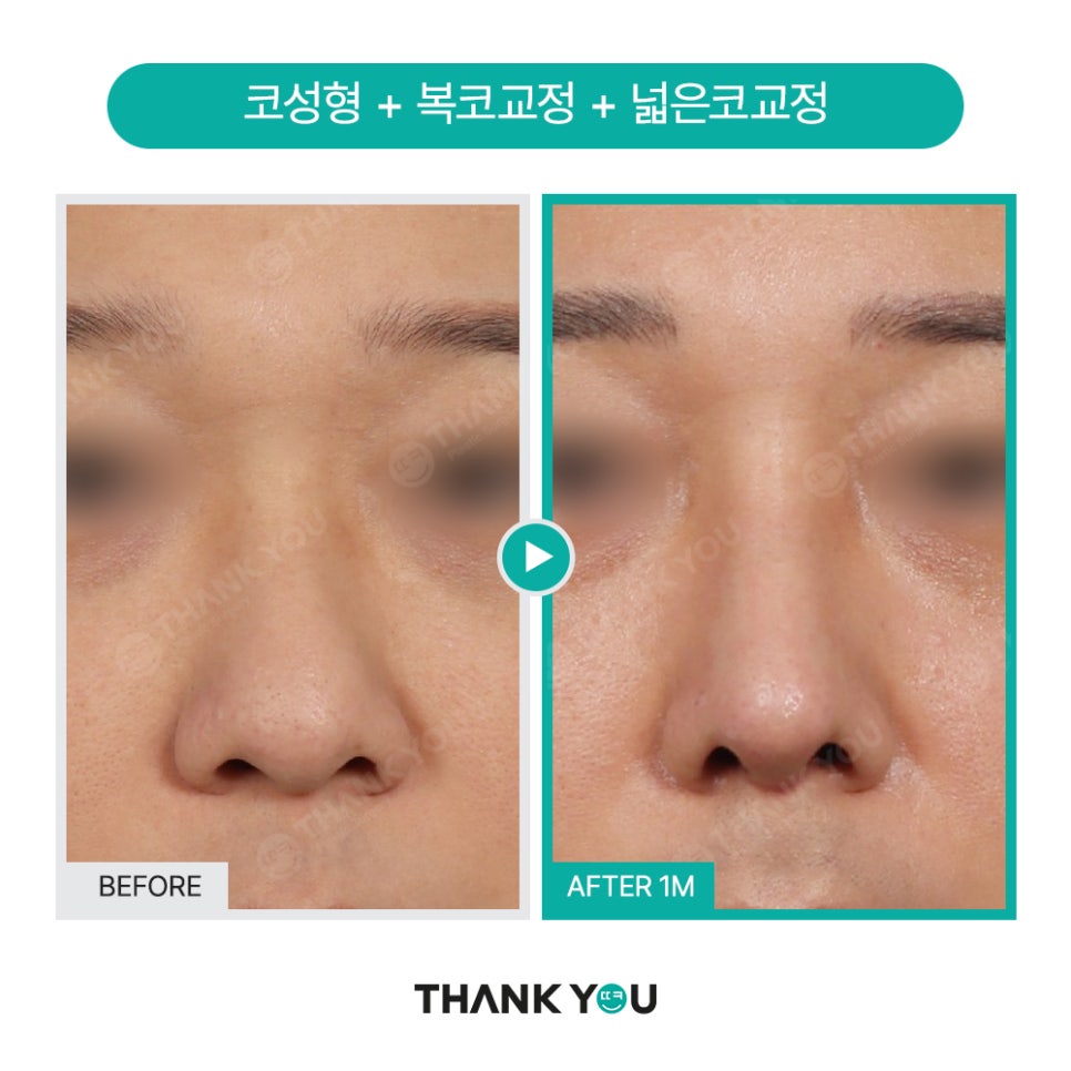 신논현역 성형외과, 남자 휜코성형, 매부리코 성공 포인트는? 관련 이미지 17