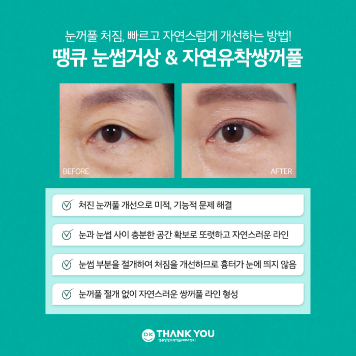 눈썹거상술 & 자연유착쌍꺼풀로 처진 눈꺼풀 효과적으로 개선! 관련 이미지 4