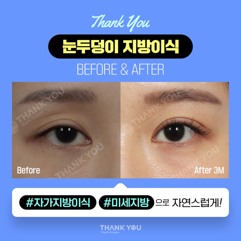 눈두덩이 지방이식, 푹꺼진 눈꺼풀에 자가지방이식으로 관련 이미지 11
