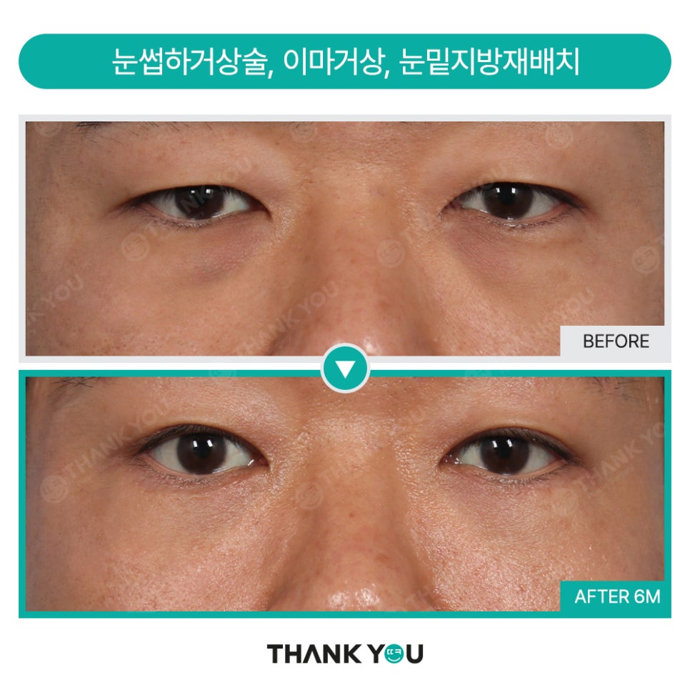 눈밑지방재배치 함께 필요한 미세 지방이식?(땡큐 나노펫) 관련 이미지 10