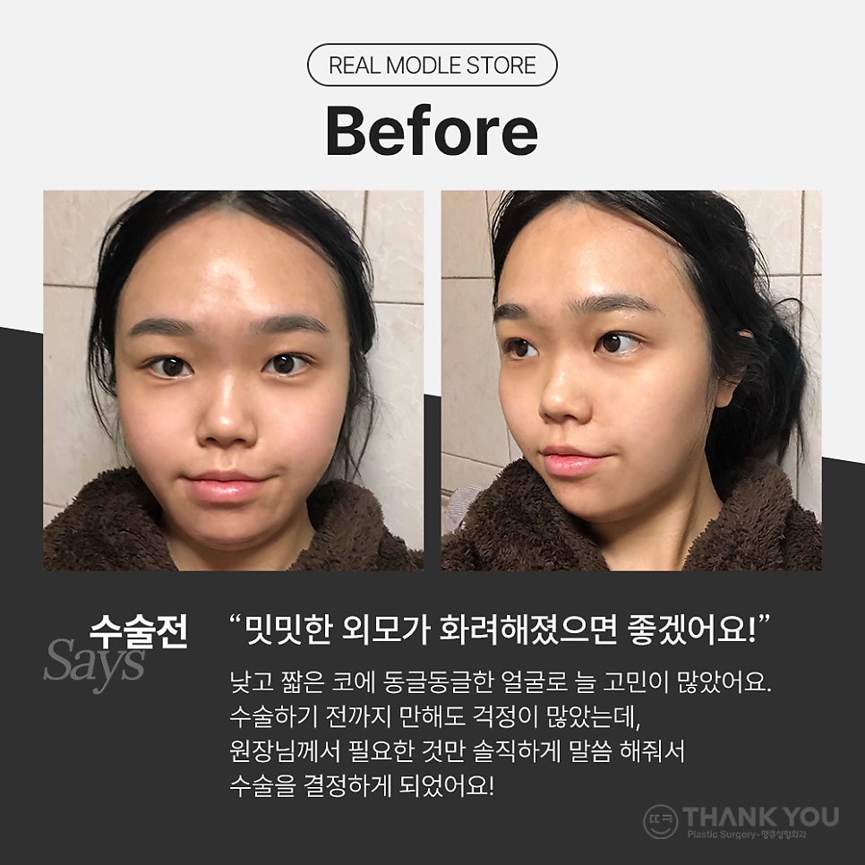 낮은코성형&얼굴지방흡입 후기 (땡큐성형외과 Real Story) 관련 이미지 3