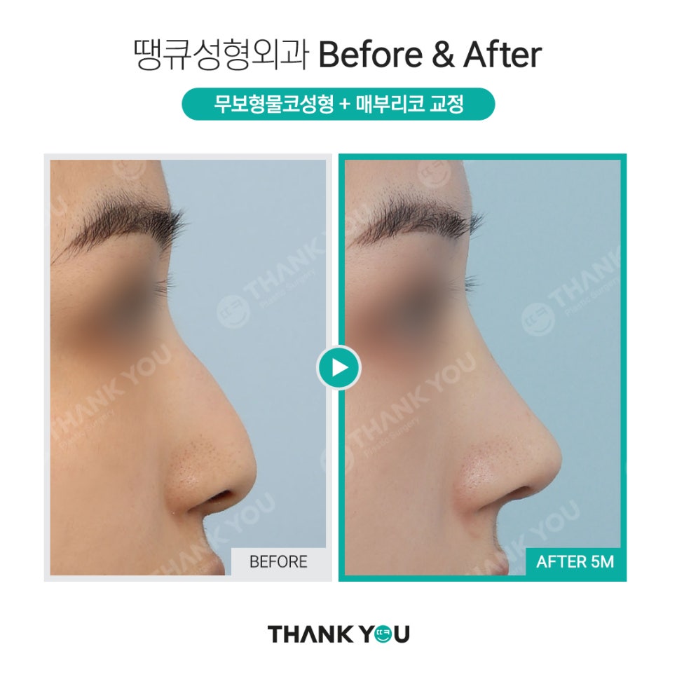 땡큐 무보형물 코성형, 비중격or 귀연골로 완성 관련 이미지 5