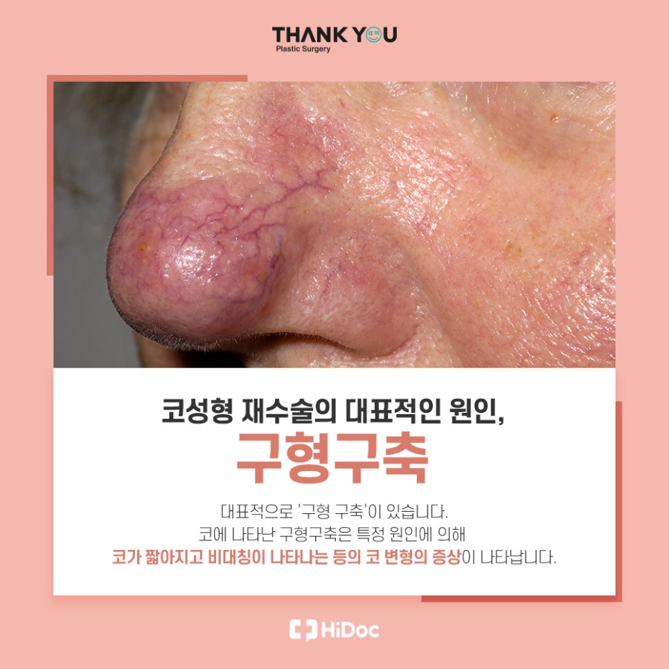 코성형 재수술 비용이 더 비싼 이유는?(수술이 더 어려운 이유) 관련 이미지 5