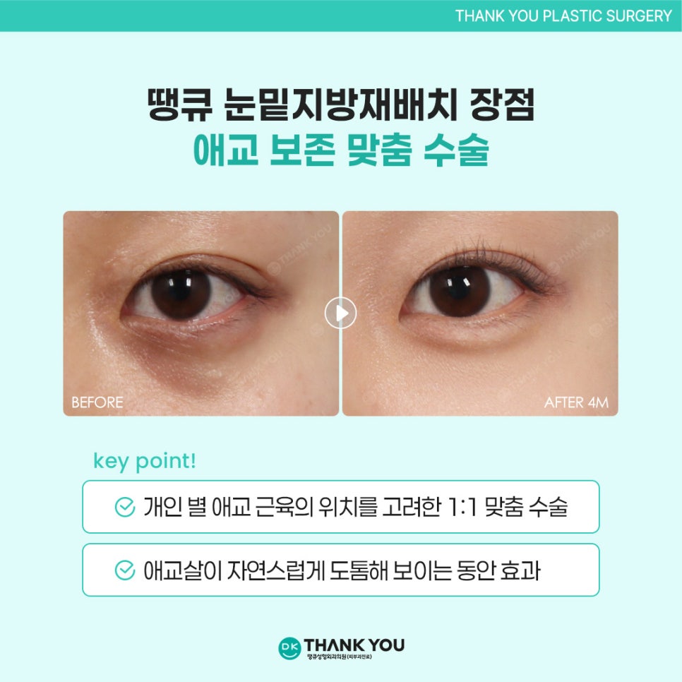 눈밑지방재배치효과? 수술 잘하는 곳 땡큐에서 확인! 관련 이미지 6