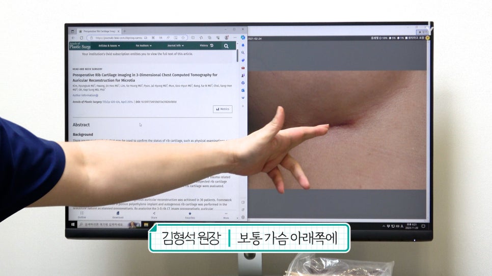 자가늑연골 코수술 장단점, 실리콘없이 무보형물 전후Check 관련 이미지 4