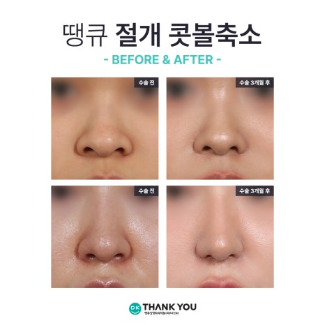 콧볼성형 찾는다면 여기! 땡큐 콧볼축소로 세련된 이미지 완성하기! 관련 이미지 13