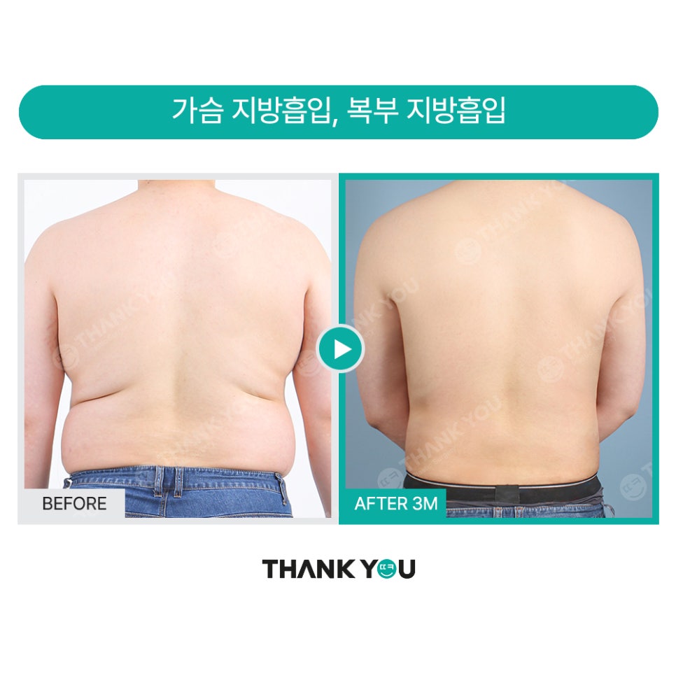 땡큐 맥미남, 뮤지컬배우 남자 복부지방흡입 전후 Check 관련 이미지 20