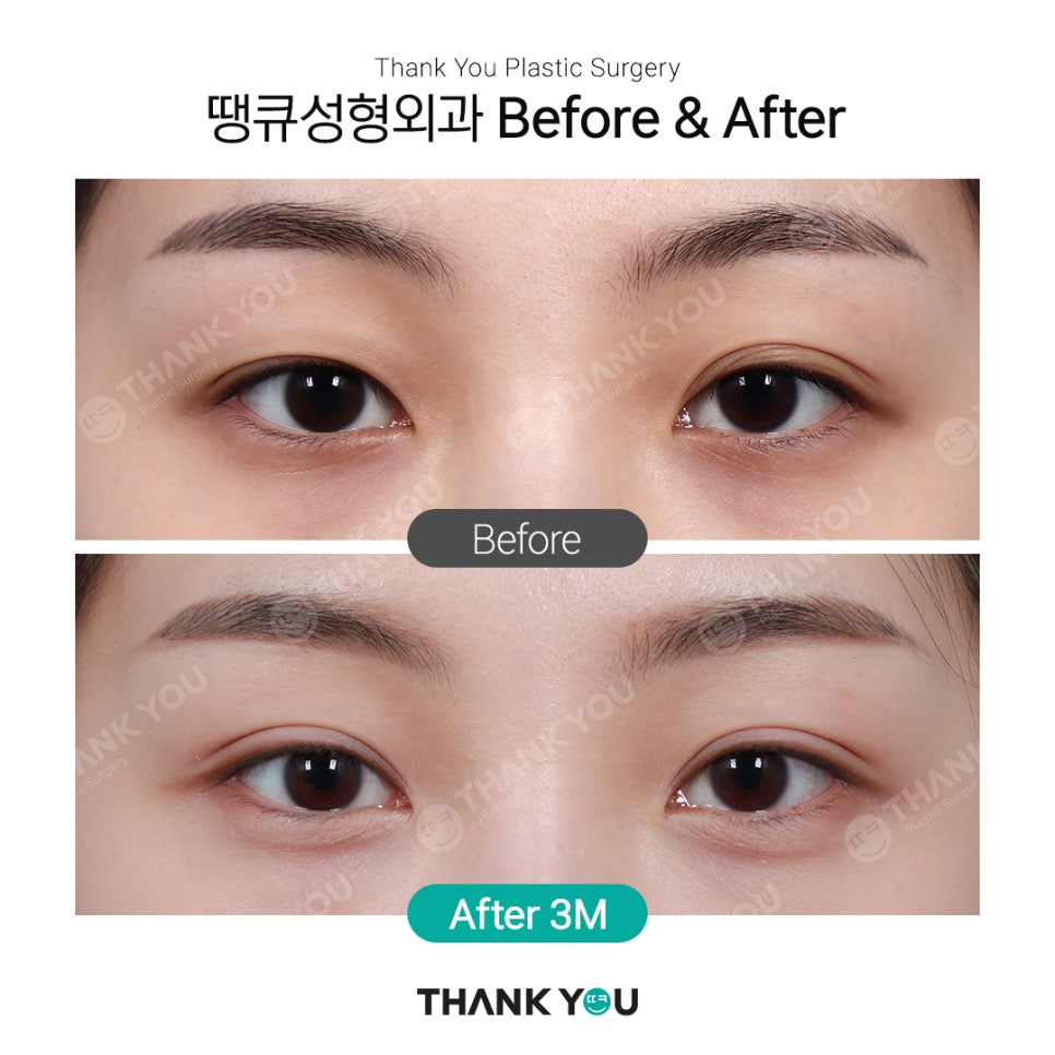 쌍꺼풀 라인 종류, 인아웃+세미아웃라인 Before After 관련 이미지 4