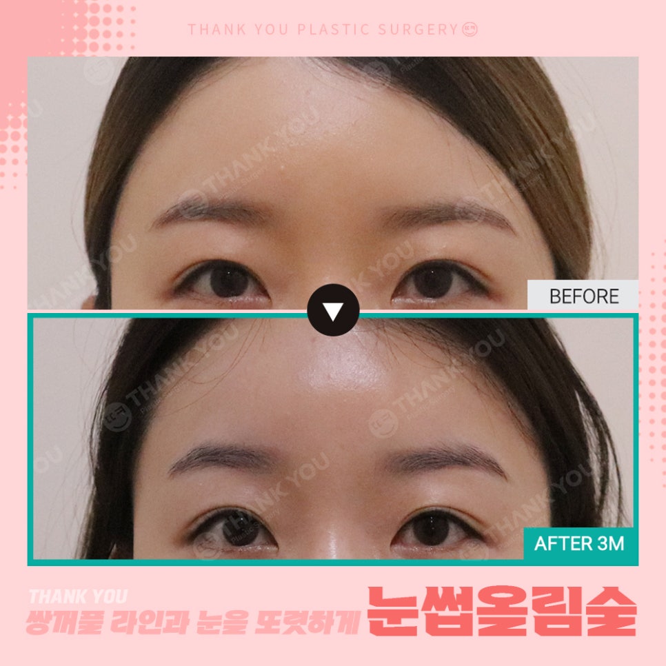 쌍수에 눈썹올림술을 추천하는 이유?! 관련 이미지 21