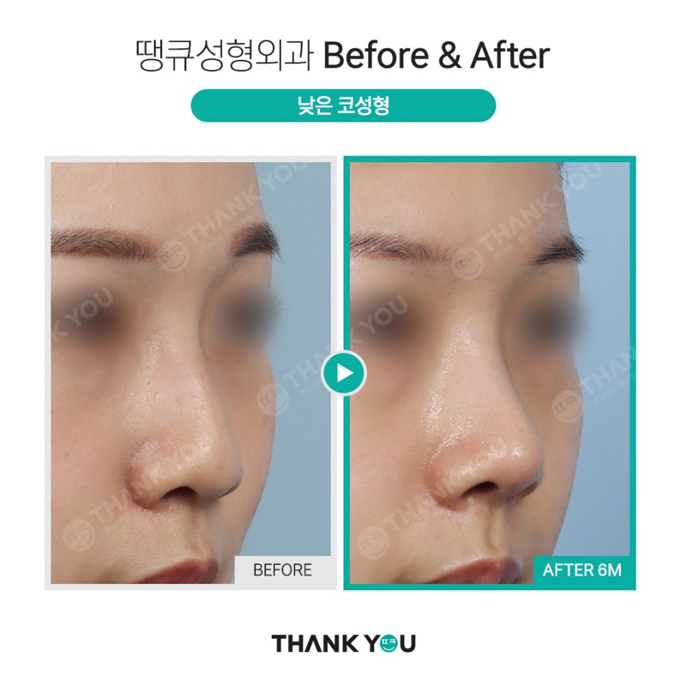 강남 코성형 전후, 코수술 잘하는 곳? 관련 이미지 10