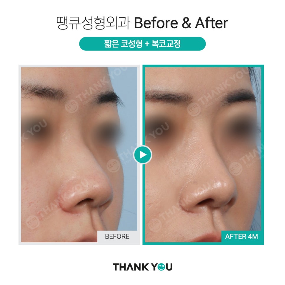 강남 코성형 전후, 코수술 잘하는 곳? 관련 이미지 6
