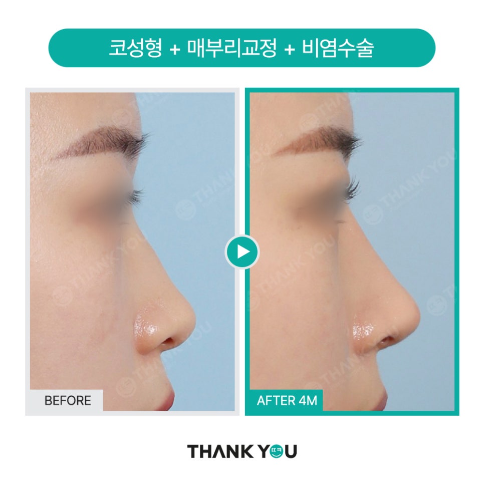 이런 코는 무조건 성공?! 코성형 성공 유형 관련 이미지 17