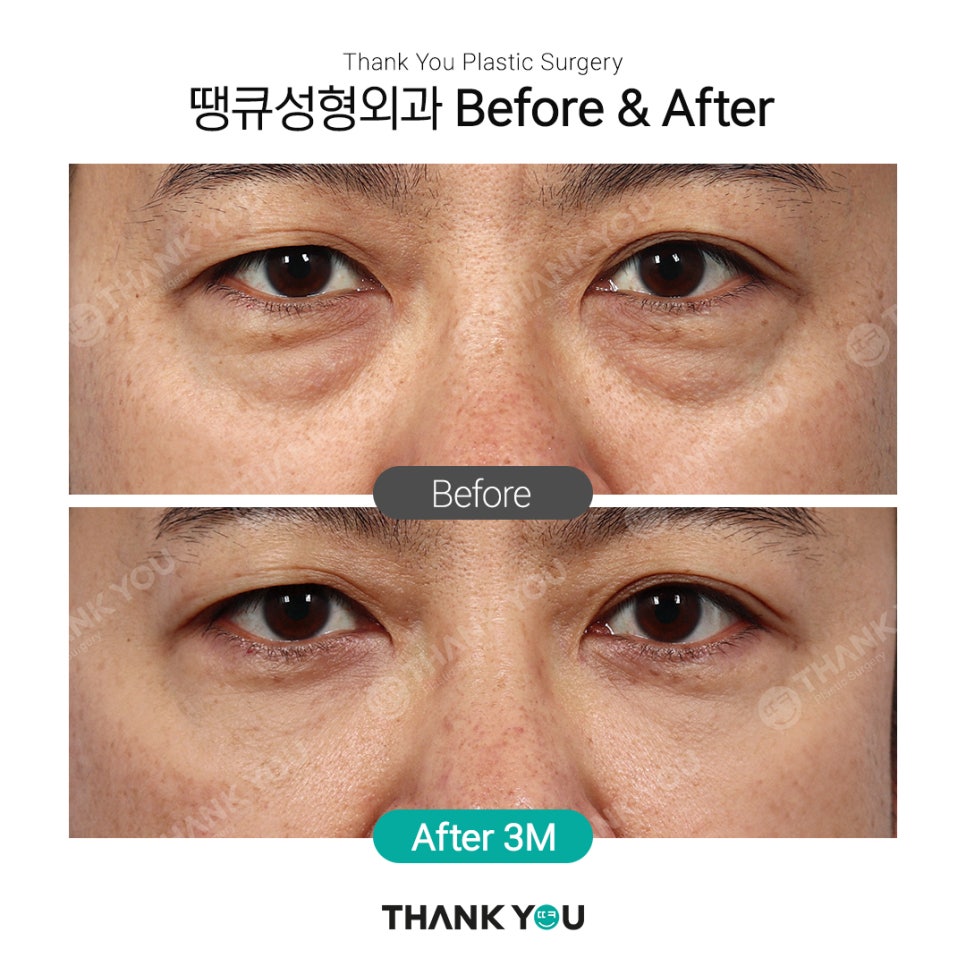 강남 눈밑지방재배치(전후 체크) THANY YOU이벤트 관련 이미지 9