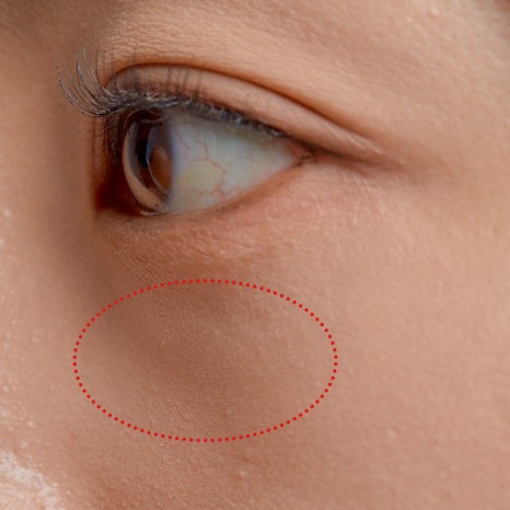 눈밑수술, 눈밑지방이식도 가능한가요? 관련 이미지 5