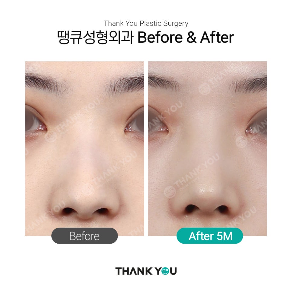 남자코성형 여자코성형 디자인 차이점 (코성형 전후) 관련 이미지 6