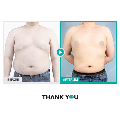 땡큐 맥미남, 뮤지컬배우 남자 복부지방흡입 전후 Check 관련 이미지 6
