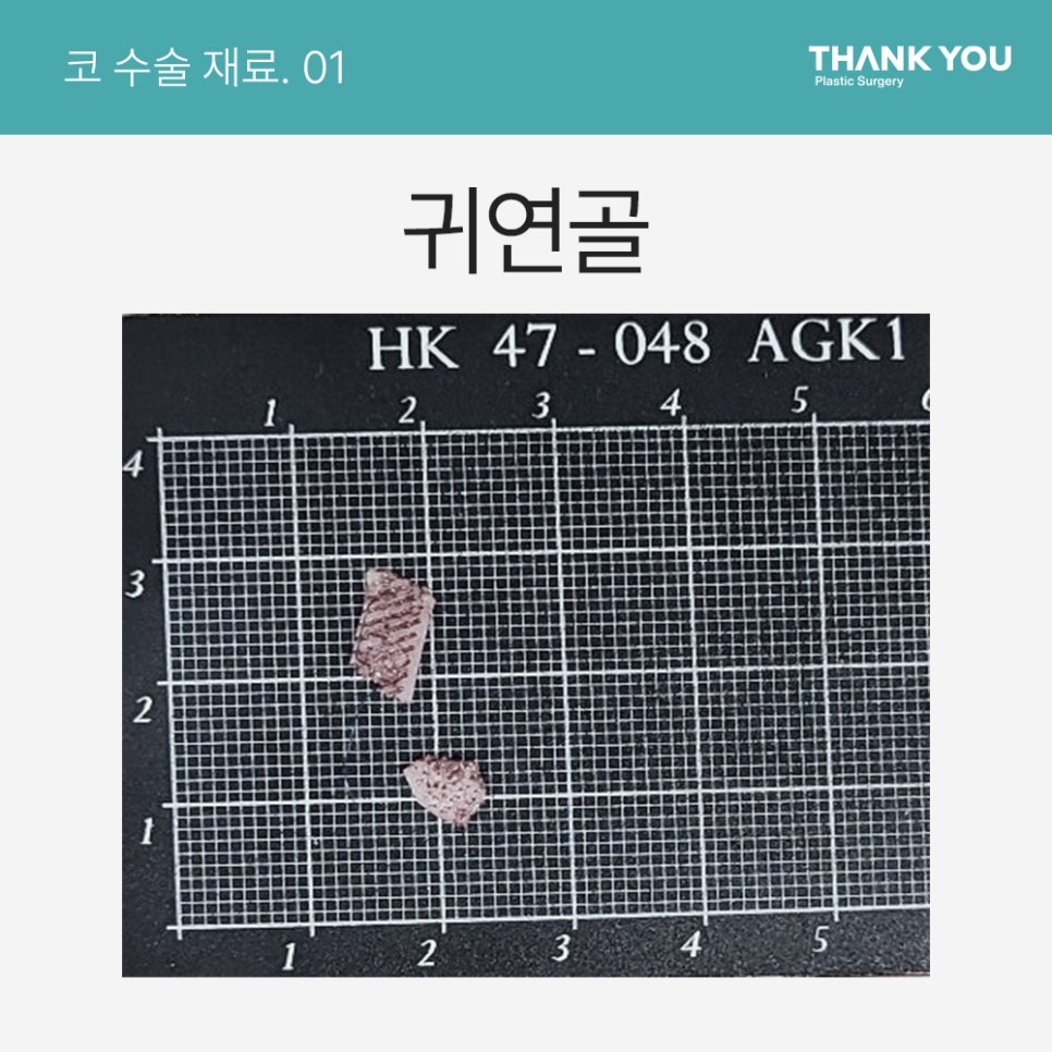 자가늑연골? 기증늑연골? 코성형수술 재료의 끝판왕? 관련 이미지 1