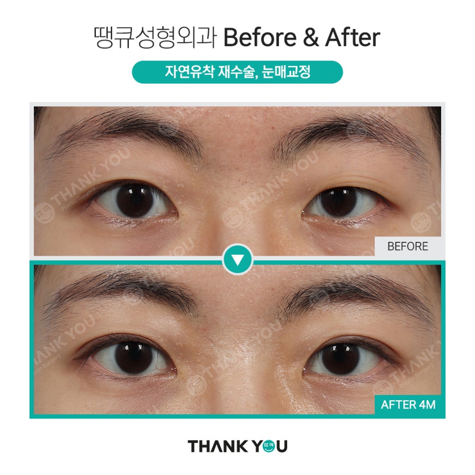 눈매교정 전후? 수술 전후사진으로 체크해요 관련 이미지 7