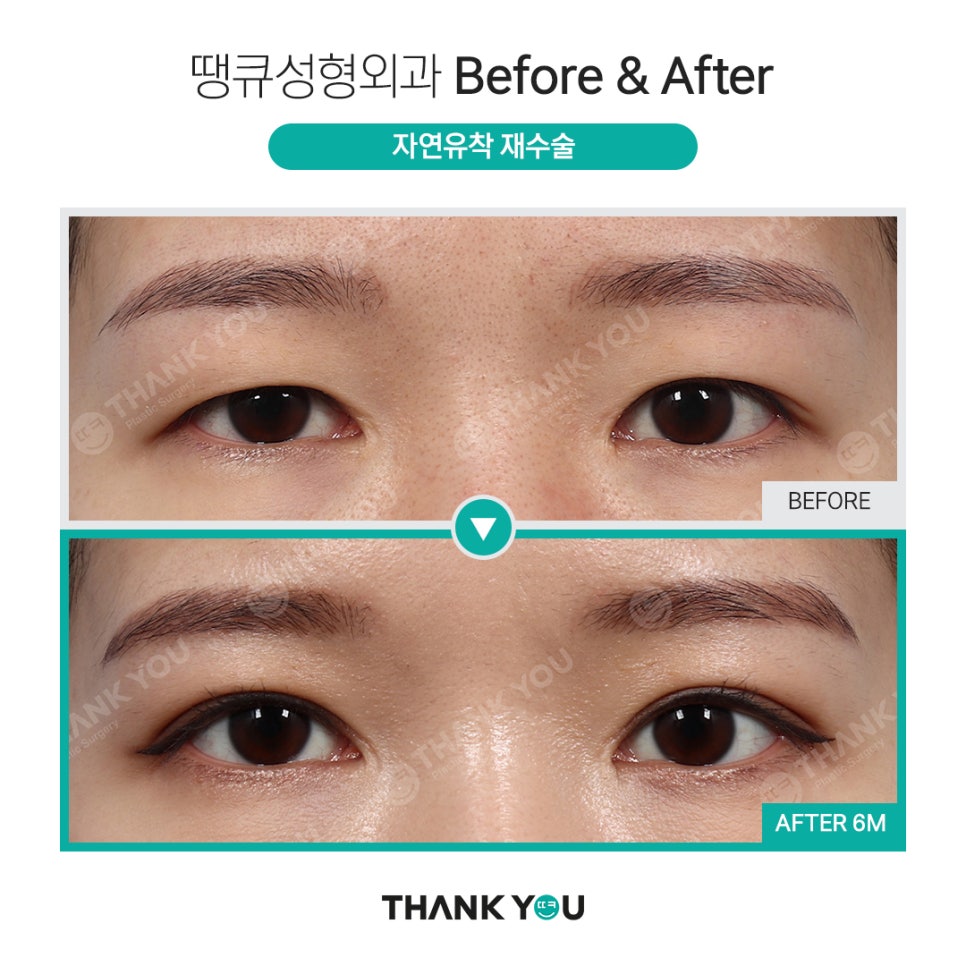 쌍수 풀기 (재수술전 실풀기+ 눈재수술 전후) 관련 이미지 13