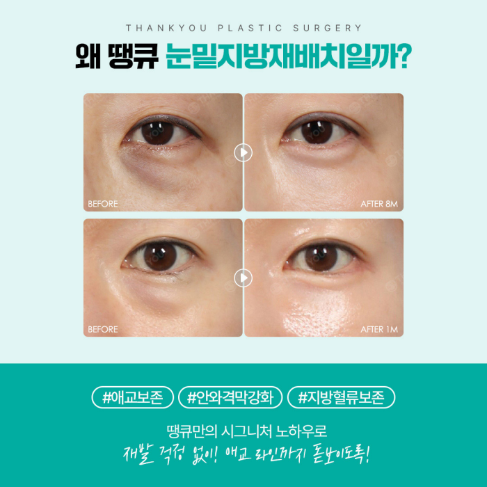 광일병 in 땡큐성형외과 ✨ 눈밑지 & 다크서클 편 공개 관련 이미지 7