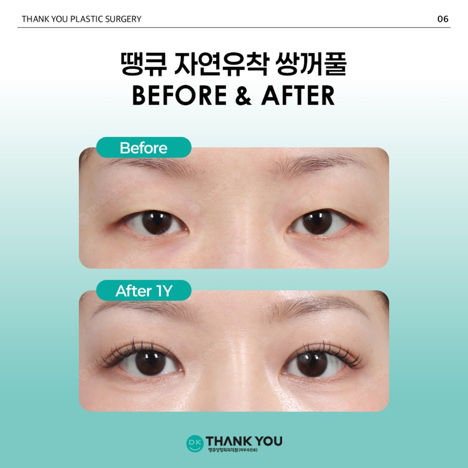 Natural Adhesion Double Eyelid Surgery Done Well: Naturally, as if It Were Meant to Be, at Thank You! image 5