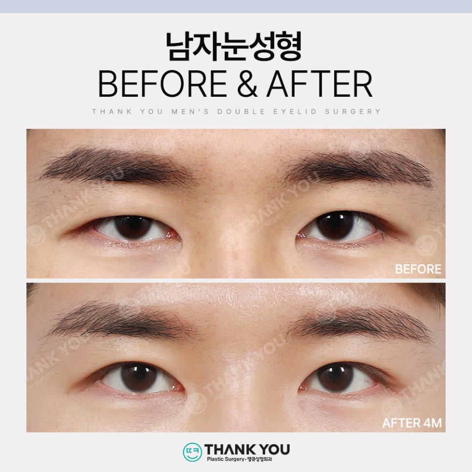 땡큐 남자눈성형 솔루션 (ft. 남자비절개 눈매교정 전후) 관련 이미지 13