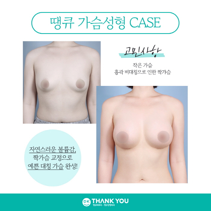 가슴성형잘하는곳에서 알려주는 가슴보형물 별 특징! 관련 이미지 8
