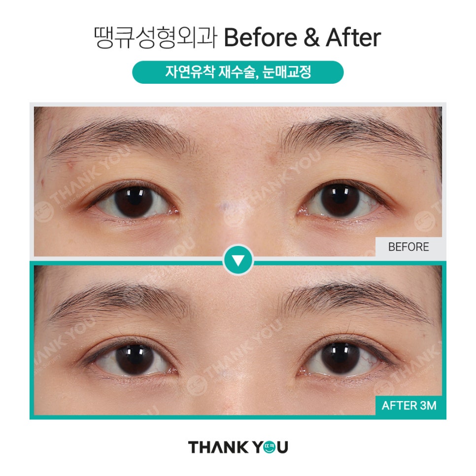 눈매교정 전후? 수술 전후사진으로 체크해요 관련 이미지 6