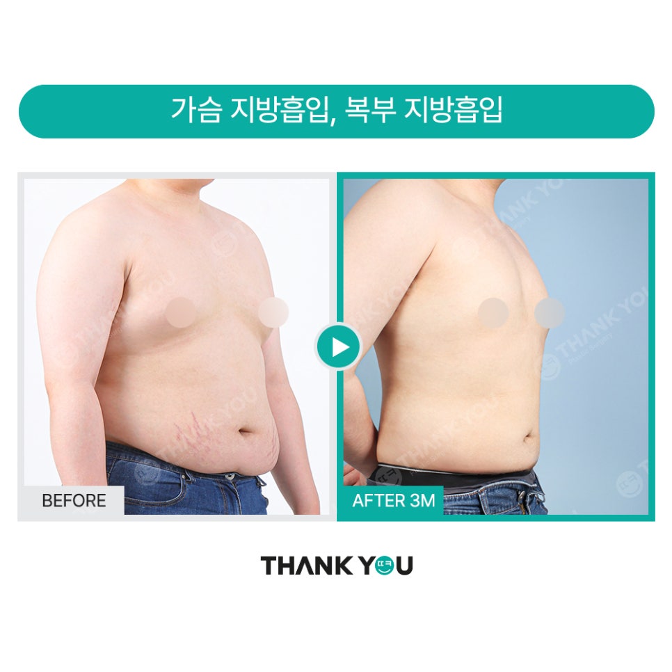 땡큐 맥미남, 뮤지컬배우 남자 복부지방흡입 전후 Check 관련 이미지 19