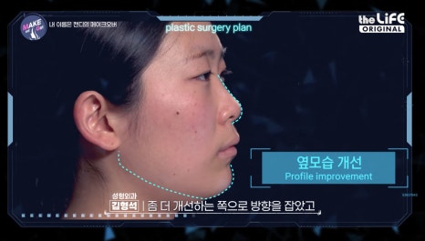 땡큐성형외과, 맥미걸 솔루션! 하비갑개수술 X 미용코, 기능&middot;미용 개선을 동시에! 관련 이미지 3