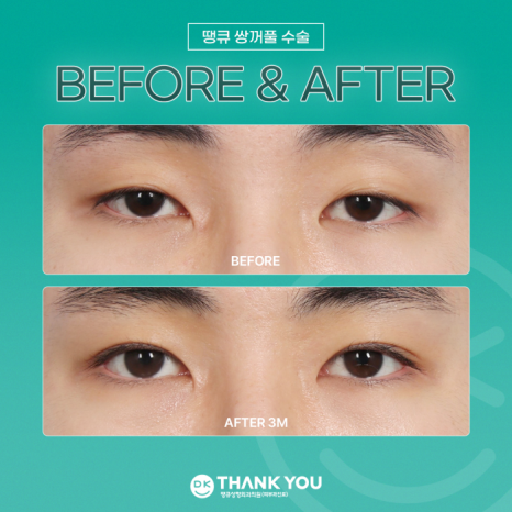 Double-Eyelid Surgery Line: Which One Suits Me Best? image 8