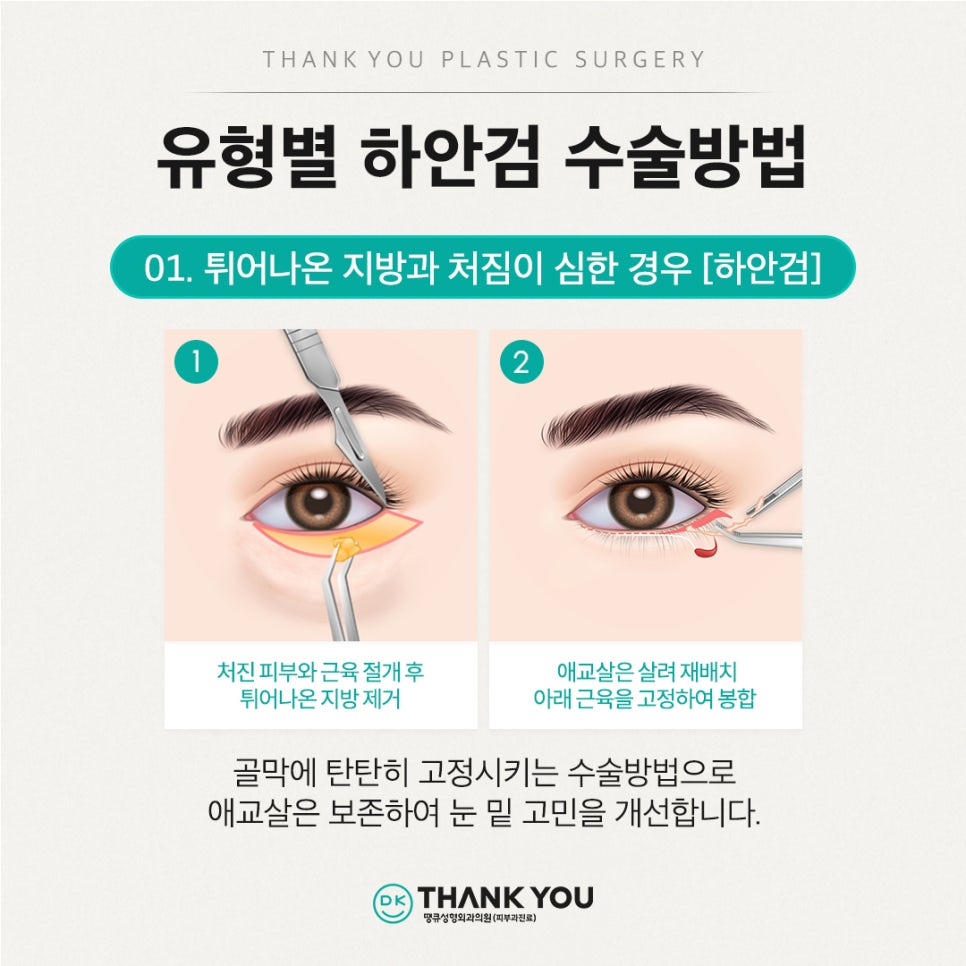 중년눈성형, 하안검수술비용 알아보기 전 이것만은 알고 가세요 관련 이미지 12