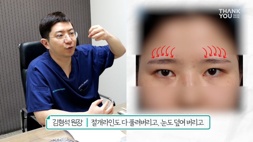 눈재수술 할 때 이마거상 추천하는 이유는? (눈썹올림술 전후) 관련 이미지 6