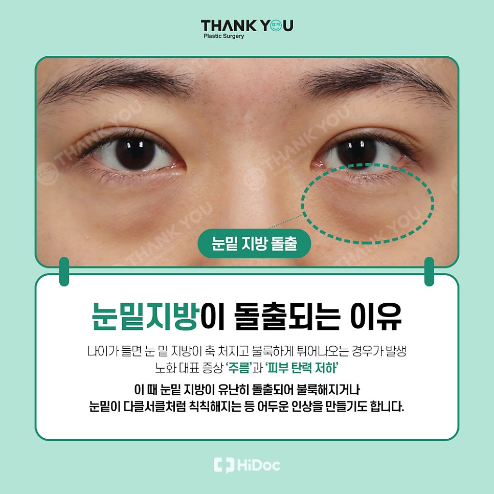눈밑지 눈밑지방제거, 하안검 차이점은? (눈밑 비포&애프터) 관련 이미지 2