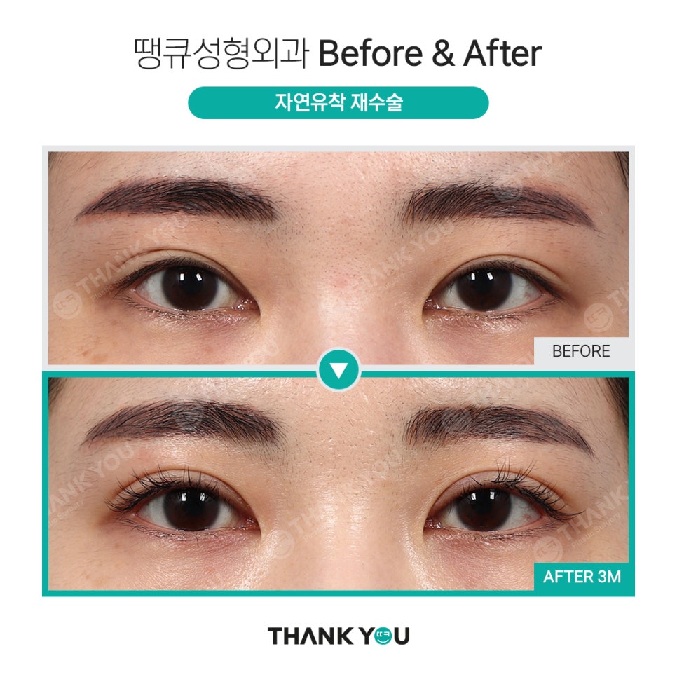 실패한 쌍수(겹주름) 눈성형 재수술 전후 사진 Point✨ 관련 이미지 5