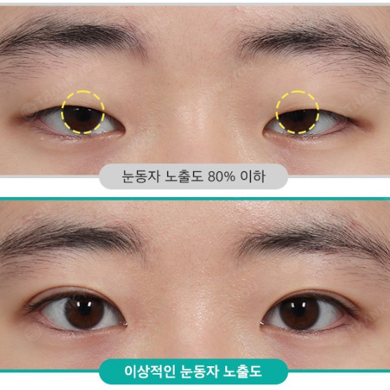 안검하수에 필요한 눈매교정 (ft.전후사진 체크) 관련 이미지 2