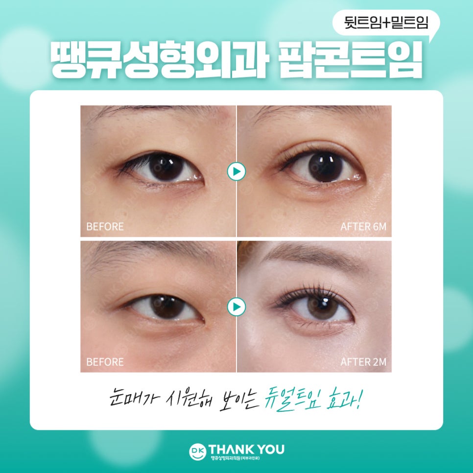 눈트임수술 [땡큐 팝콘트임]으로 듀얼트임 효과내기✨ 관련 이미지 3