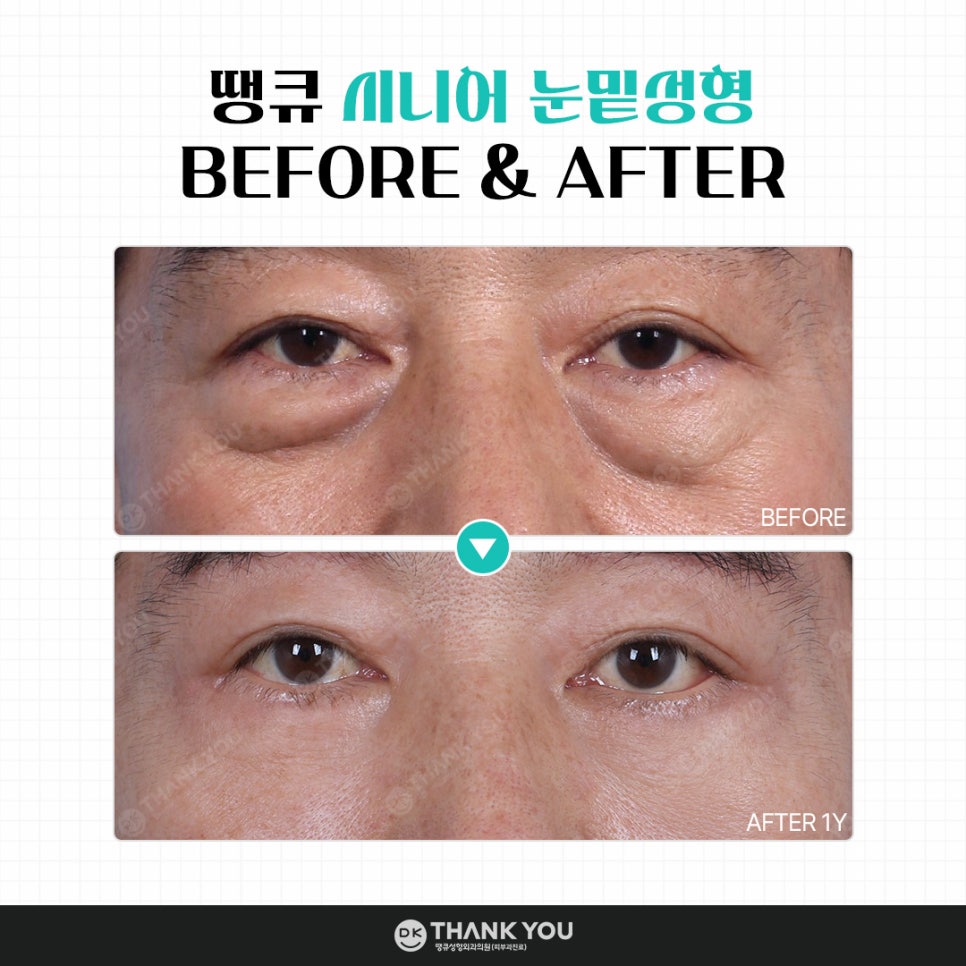 눈밑성형, 연령별로 달라지는 수술법! 무엇이 다를까? 관련 이미지 10