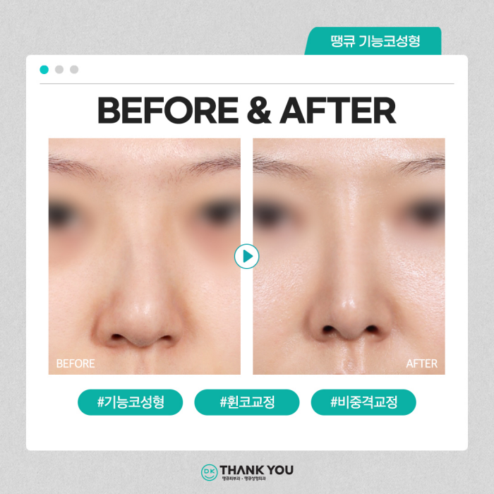 기능코수술병원에서 콧 속 불편함, 외적 스트레스 동시 해소! 관련 이미지 2