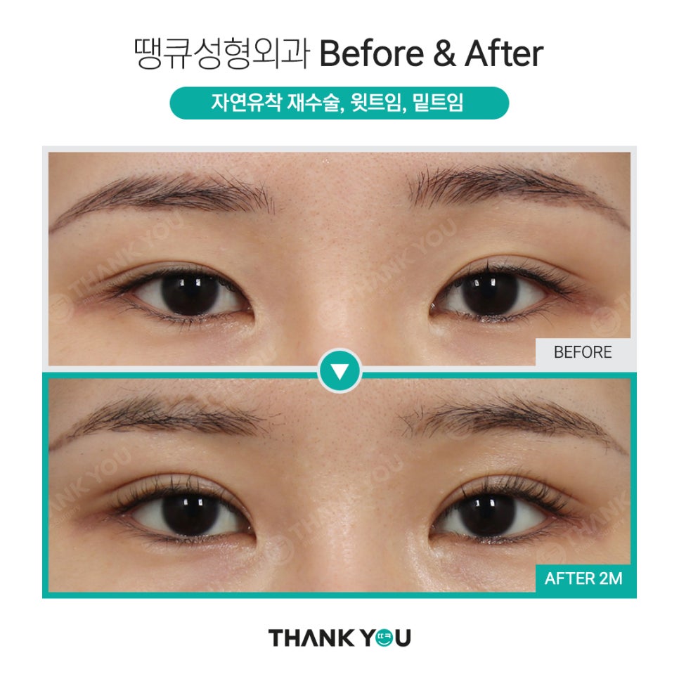 쌍수 윗트임 전후, 내게 맞춘 쌍트 수술로 화려하게 관련 이미지 4