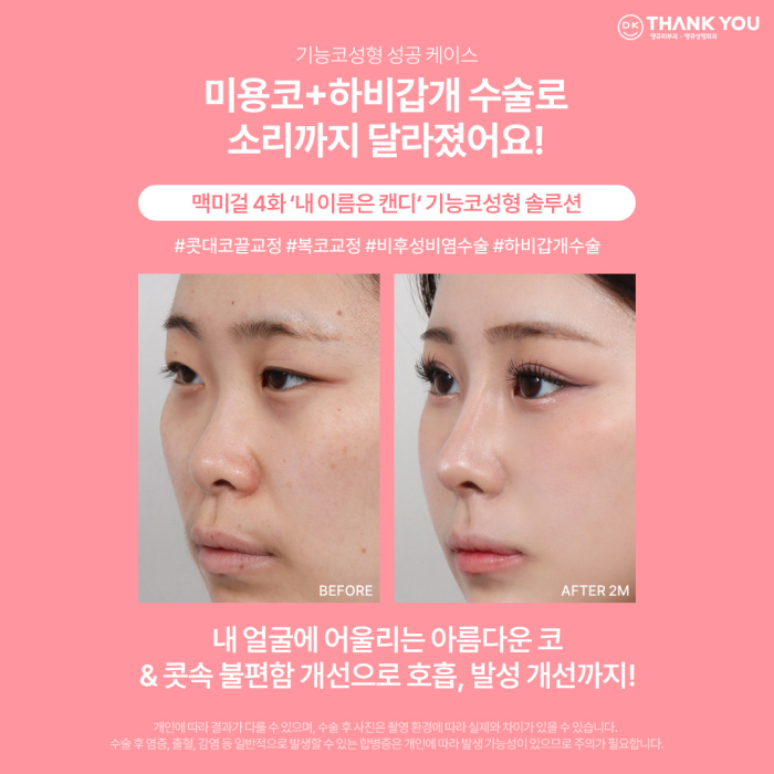 비염기능코수술과 미용코 성형을 동시에! 기능코성형 효과는?! 관련 이미지 7