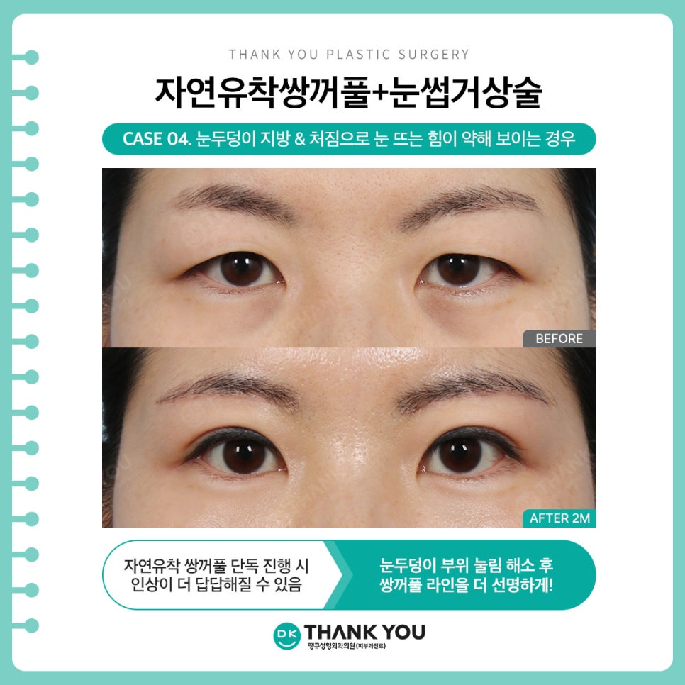 자연유착쌍커풀 + 눈썹하거상술, 자연스러운 라인에 처진 눈 개선까지?! 관련 이미지 7